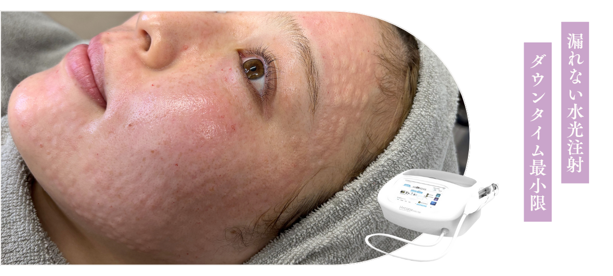 大阪で水光注射ならジョリスキンクリニック | 肌にハリツヤを持たせ