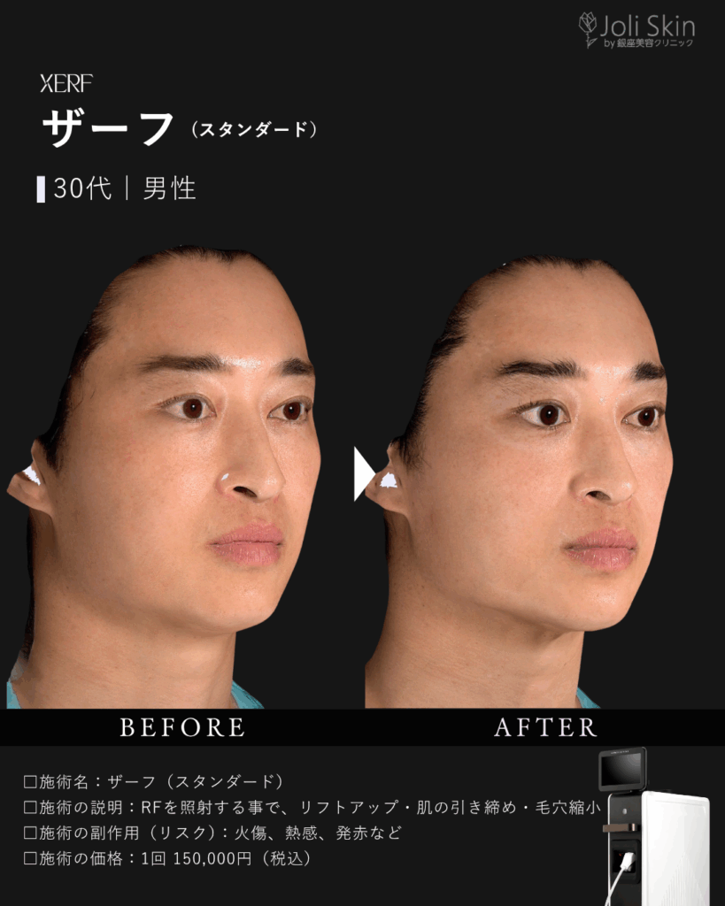 ザーフ症例写真