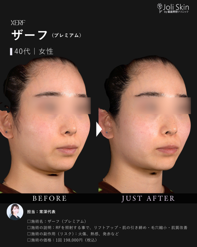 XERF(ザーフ)【Joli Skin】ジョリスキンクリニック｜大阪の美容クリニック