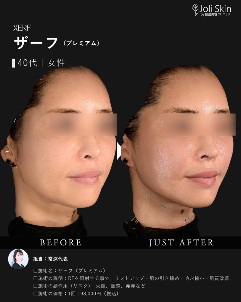 XERF(ザーフ)【Joli Skin】ジョリスキンクリニック｜大阪の美容クリニック