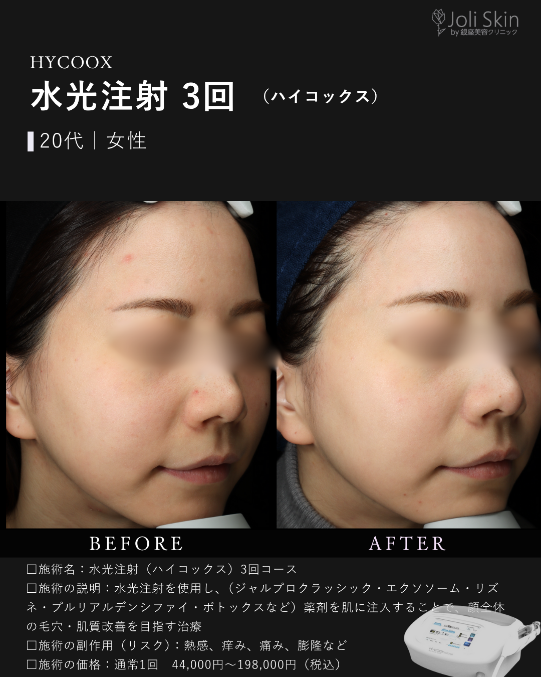 水光注射症例写真-1
水光注射(ハイコックス)3回コース