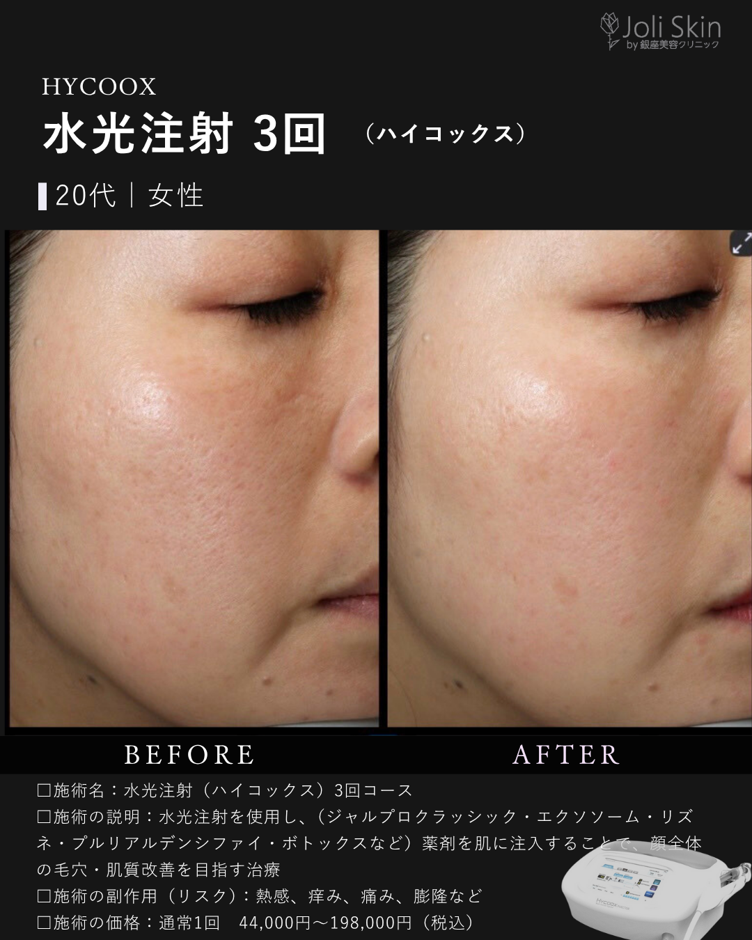 水光注射症例写真-2
水光注射(ハイコックス)3回コース