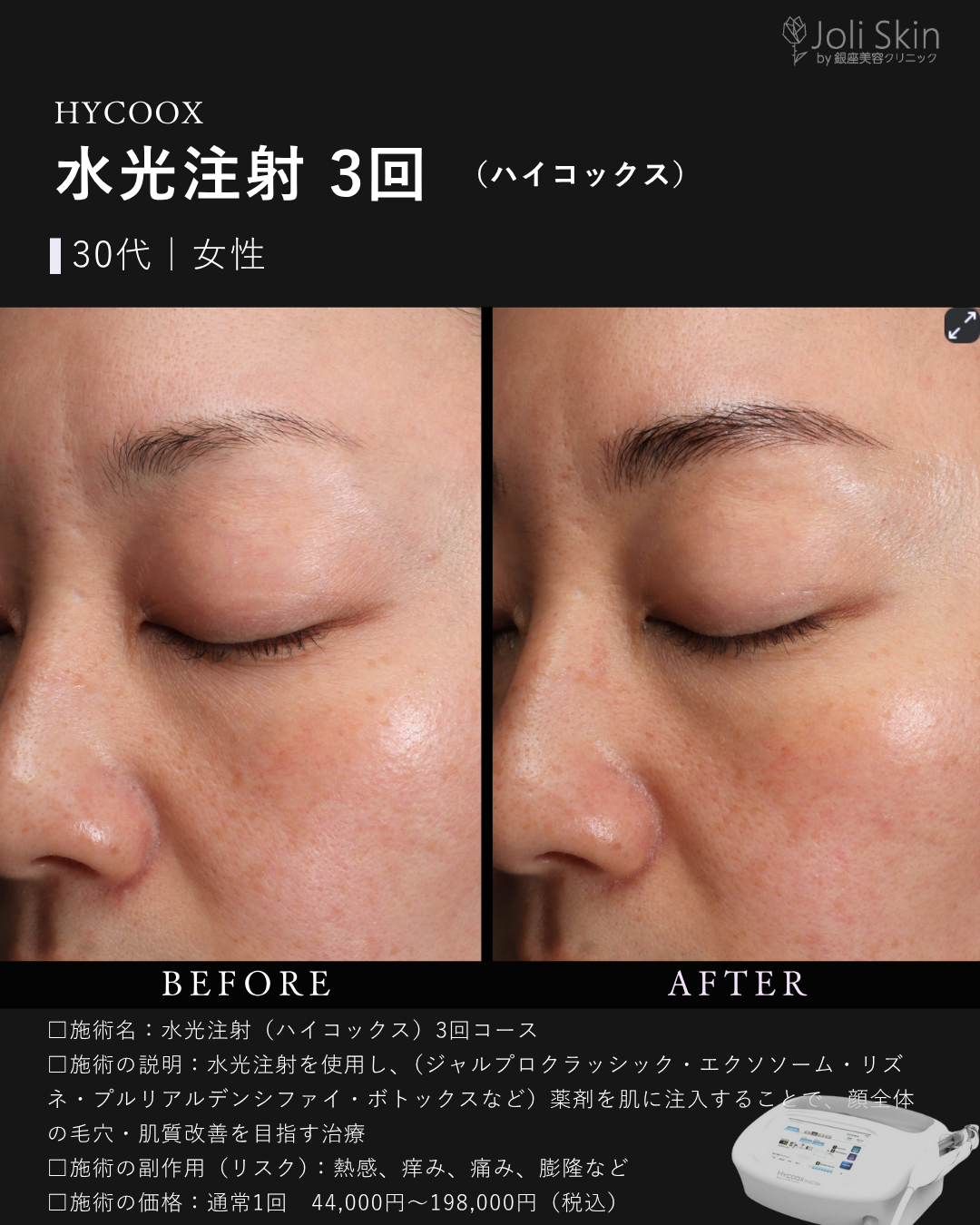 水光注射症例写真-3
水光注射(ハイコックス)3回コース