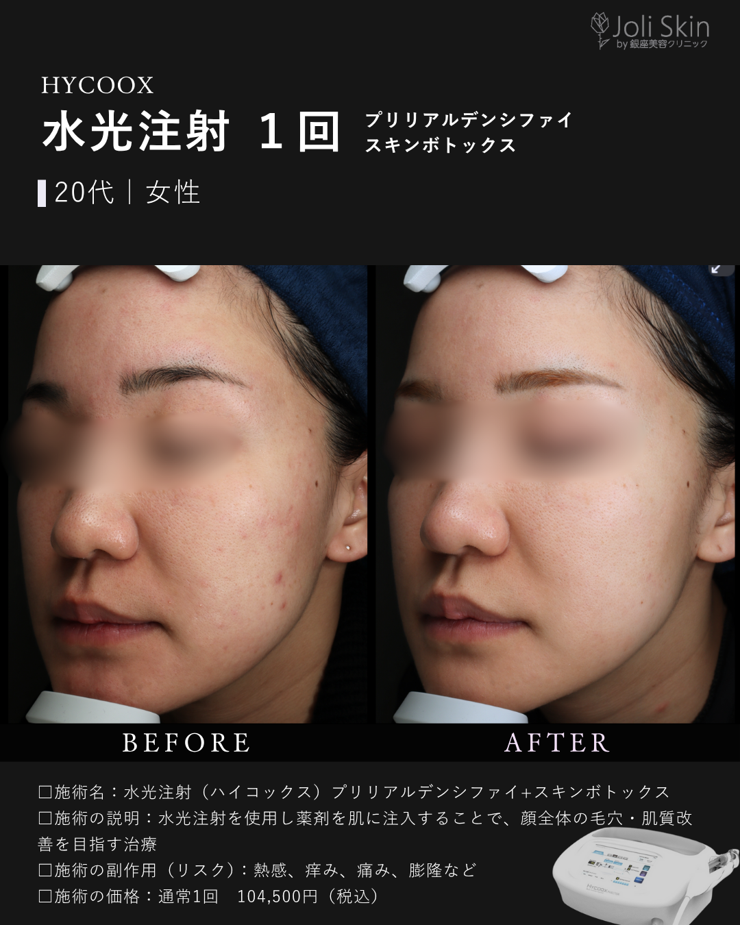 水光注射症例写真-4
水光注射(ハイコックス)プリリアルデンシファイ+スキンボトックス