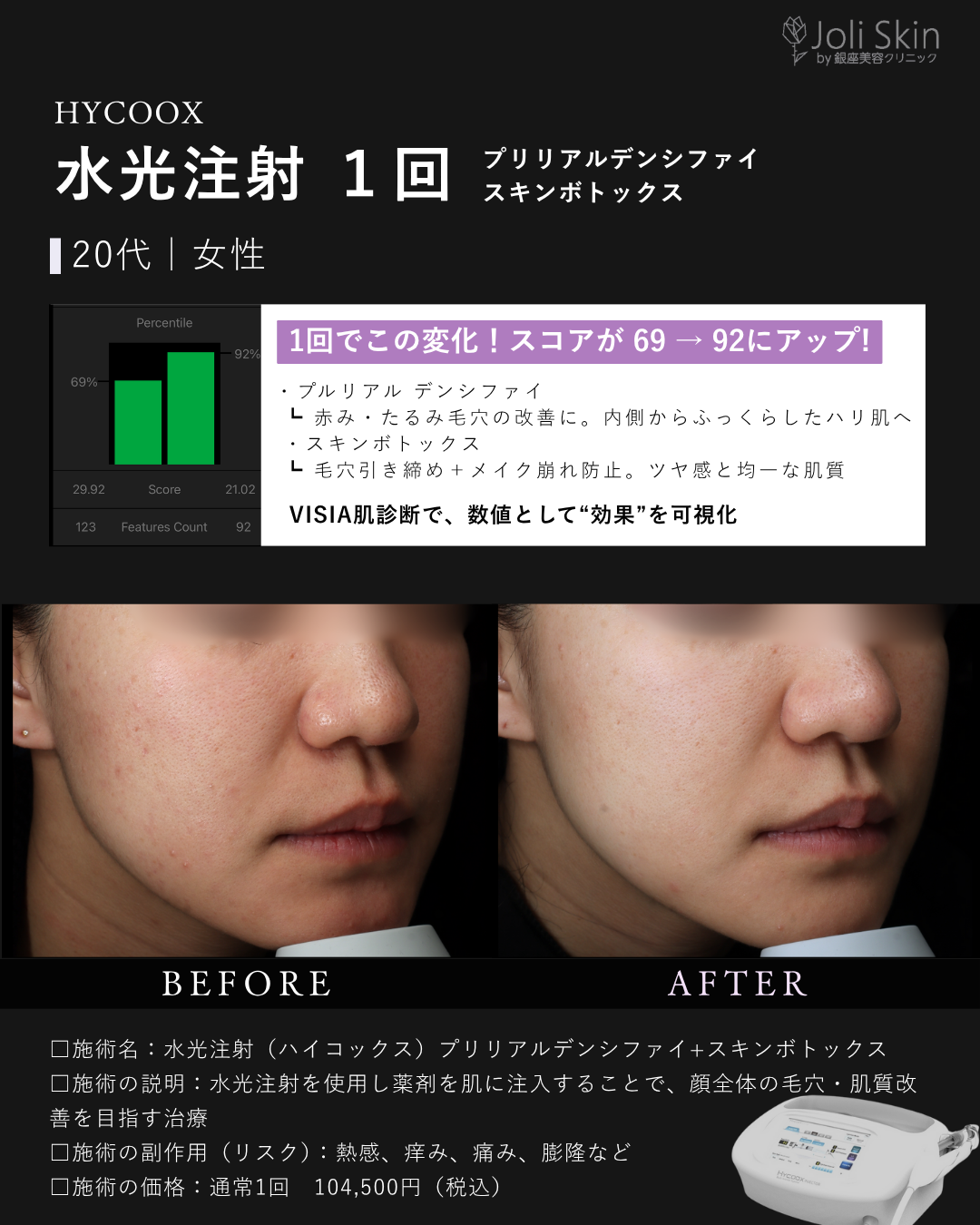 水光注射症例写真-5
水光注射(ハイコックス)プリリアルデンシファイ+スキンボトックス