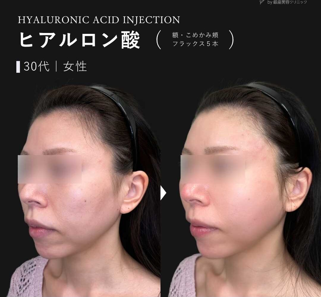 ヒアルロン酸注入 症例写真 | ジョリスキンクリニック