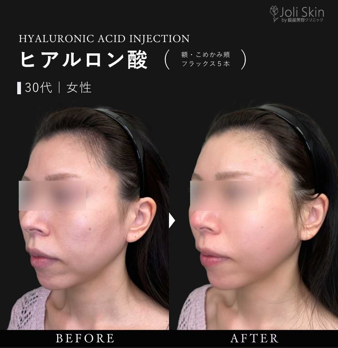 ヒアルロン酸注入症例写真 case0128｜注入治療・輪郭形成