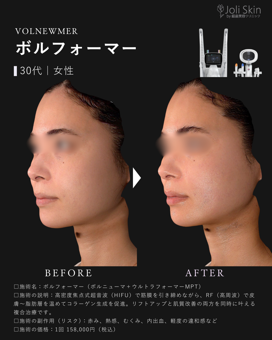 ボルフォーマー症例写真-1
ボルフォーマー（ボルニューマ＋ウルトラフォーマーMPT）