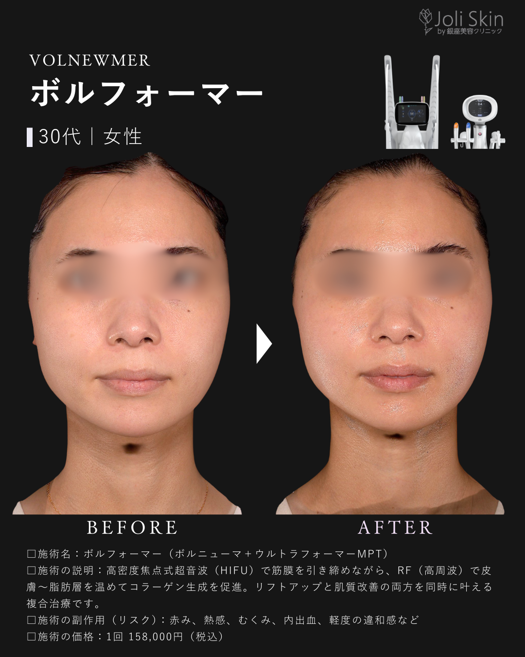 ボルフォーマー症例写真-2
ボルフォーマー（ボルニューマ＋ウルトラフォーマーMPT）