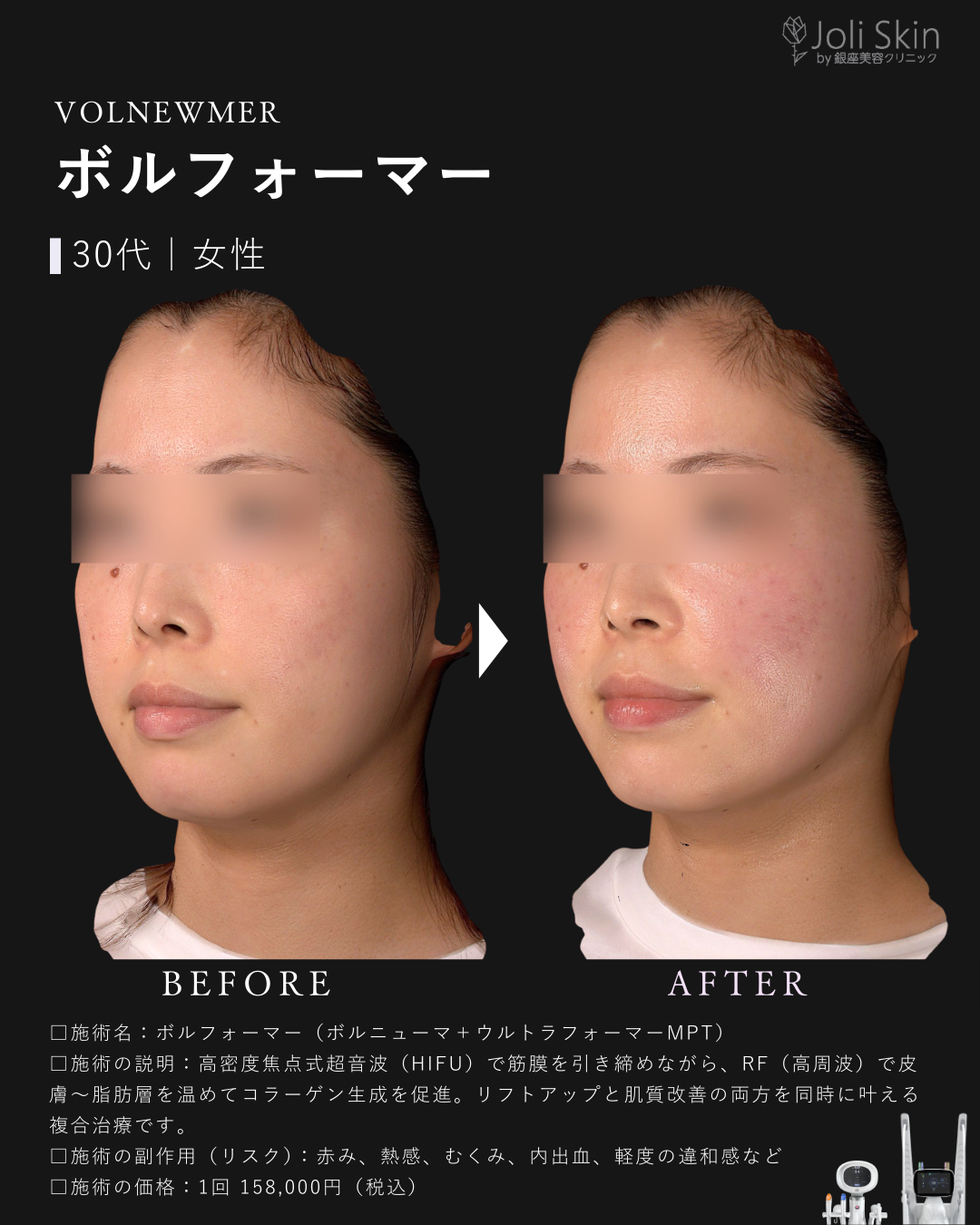 ボルフォーマー症例写真-3
ボルフォーマー（ボルニューマ＋ウルトラフォーマーMPT）