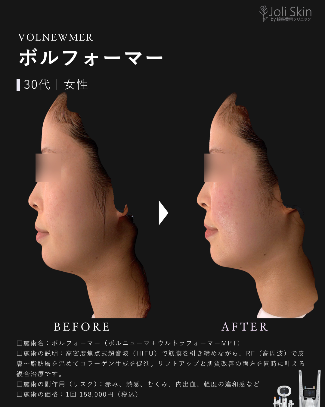 ボルフォーマー症例写真-4
ボルフォーマー（ボルニューマ＋ウルトラフォーマーMPT）