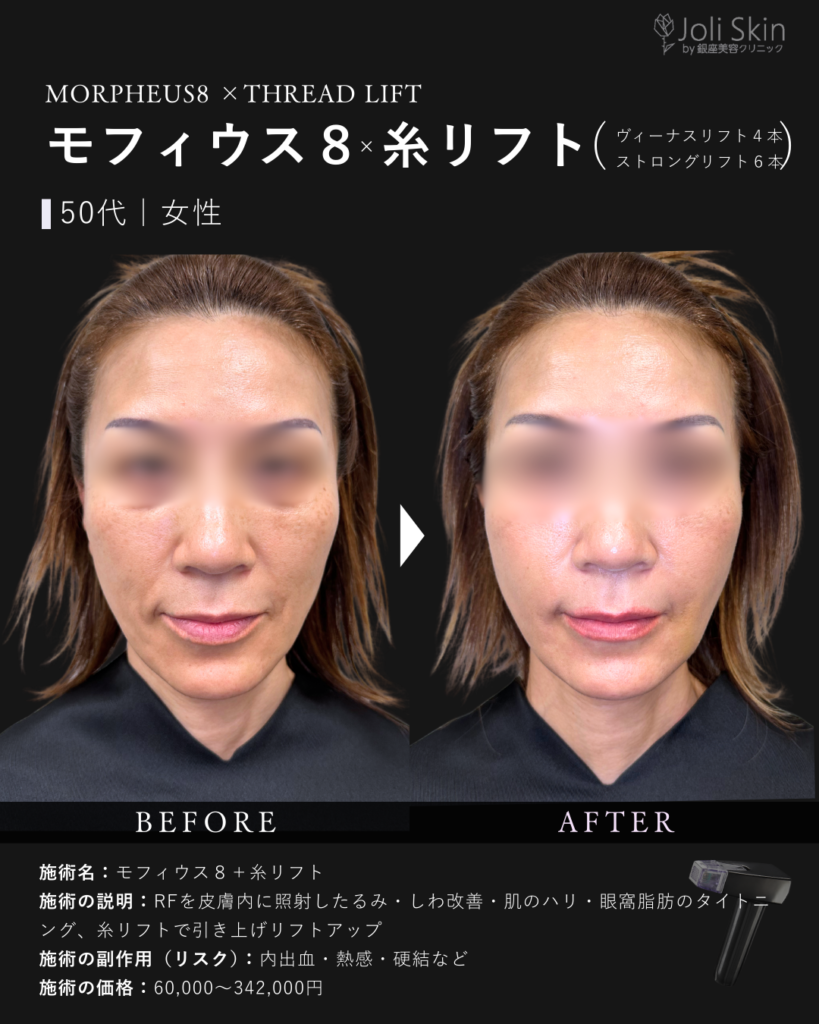 モフィウス×糸リフト