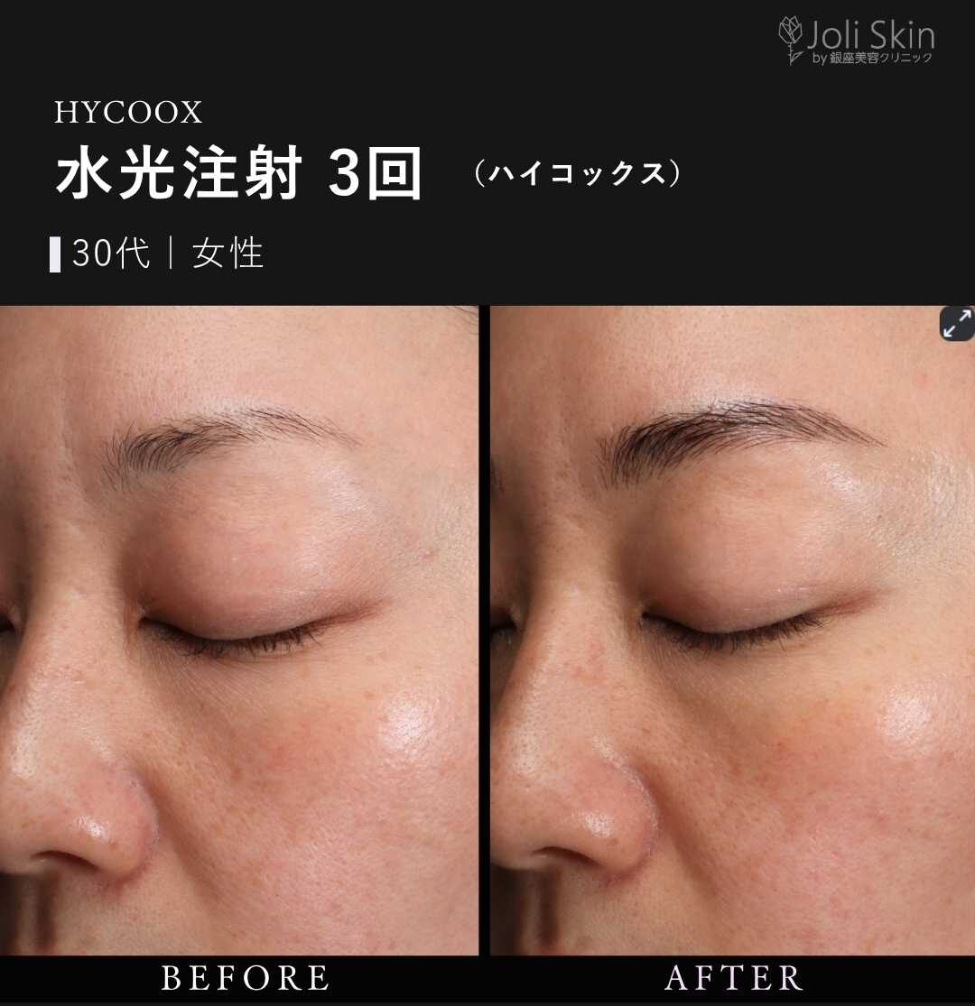 水光注射 水光注射(ハイコックス)症例写真 case0131｜肌管理・ハリ改善