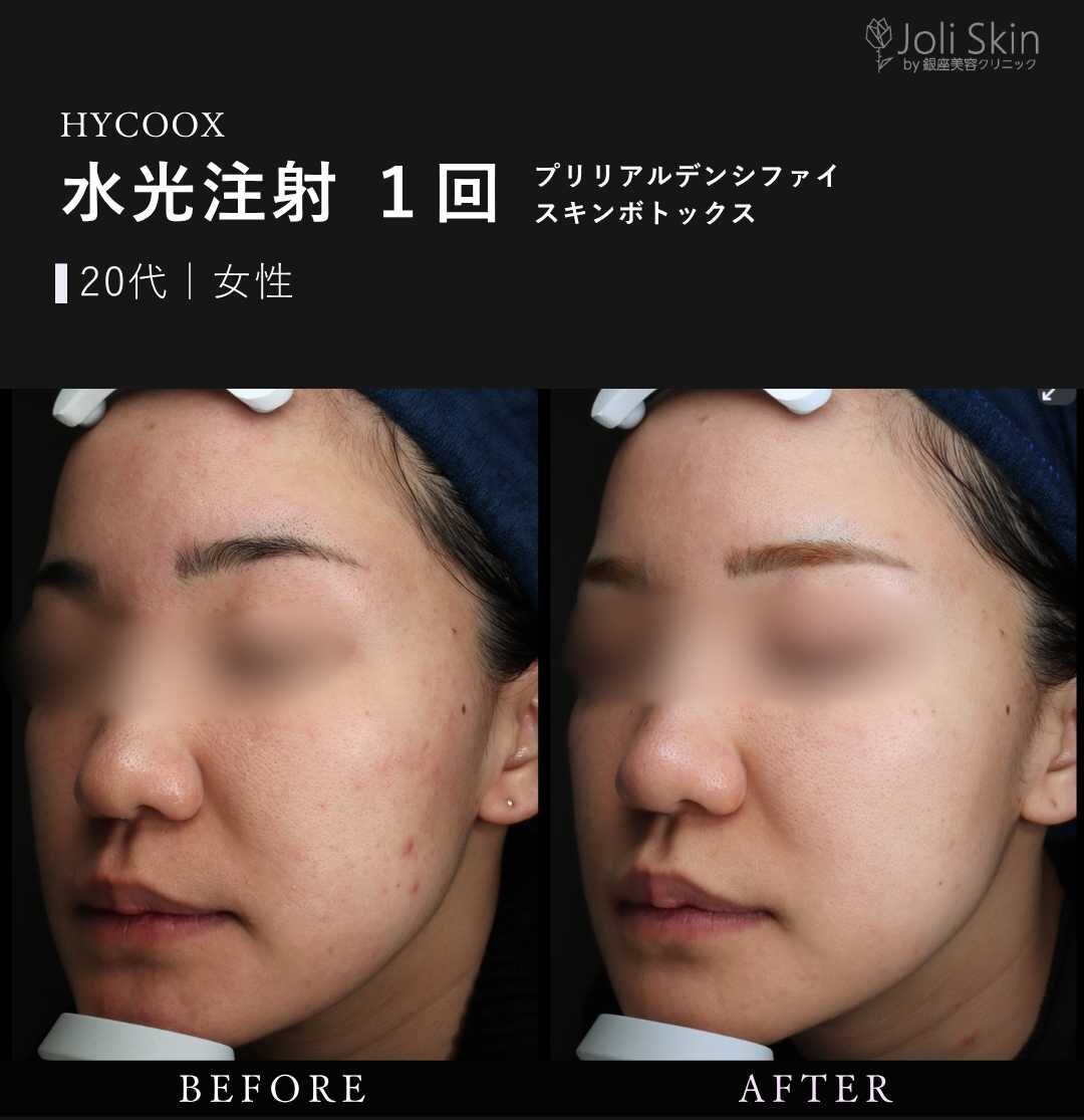 水光注射 水光注射(ハイコックス)症例写真 case0132｜肌管理・ハリ改善