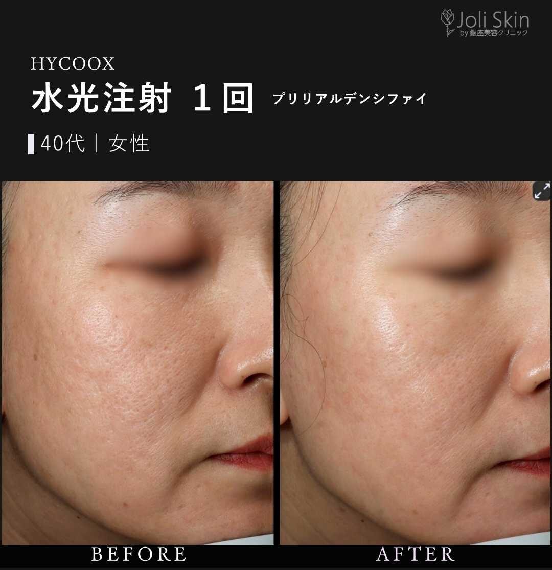 水光注射 水光注射(ハイコックス)症例写真 case0133｜肌管理・ハリ改善