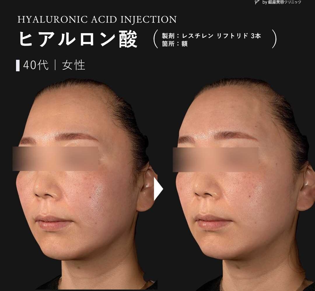 ヒアルロン酸注入 症例写真 | ジョリスキンクリニック