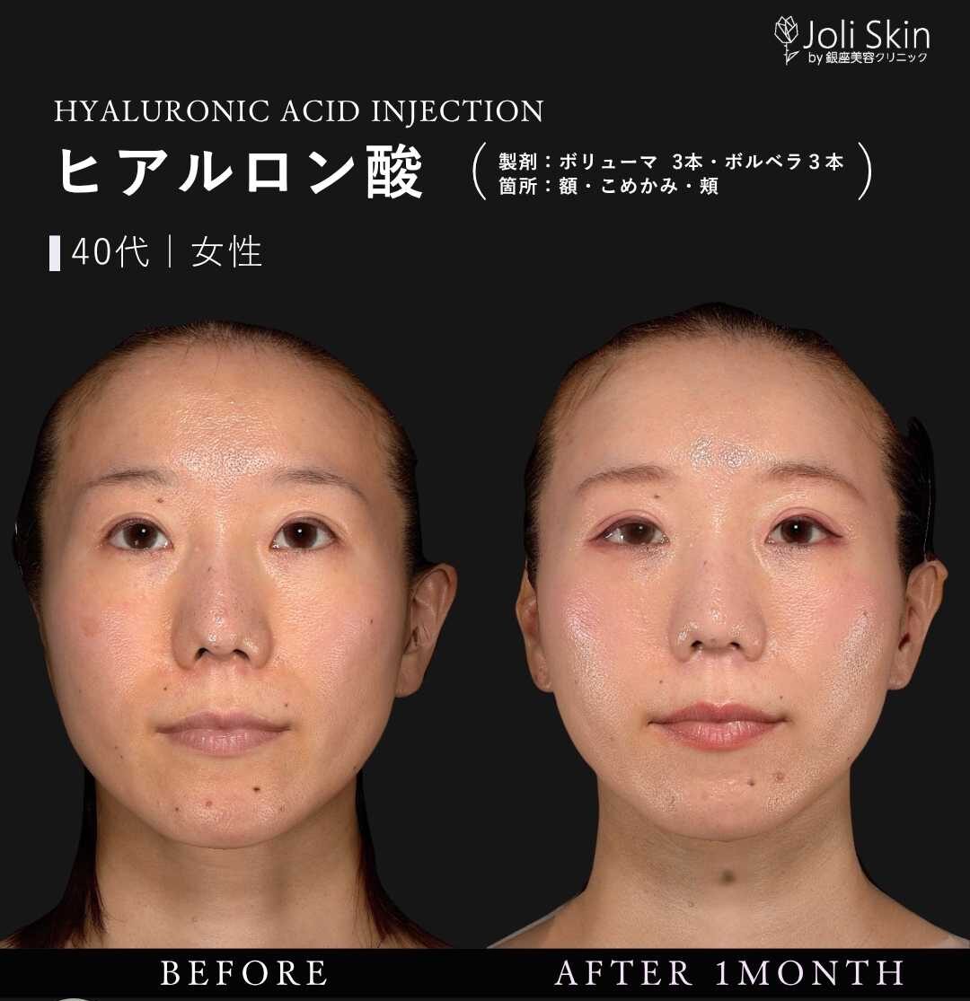 ヒアルロン酸注入 症例写真 | ジョリスキンクリニック