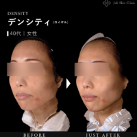 デンシティの症例