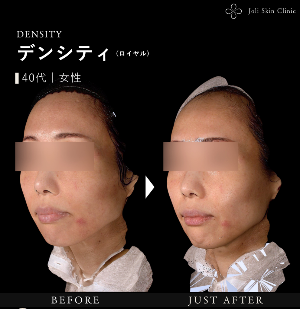 デンシティの症例