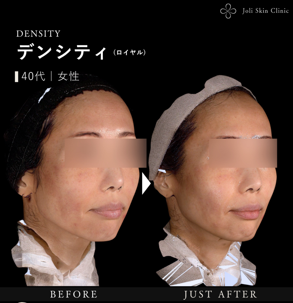 デンシティの症例
