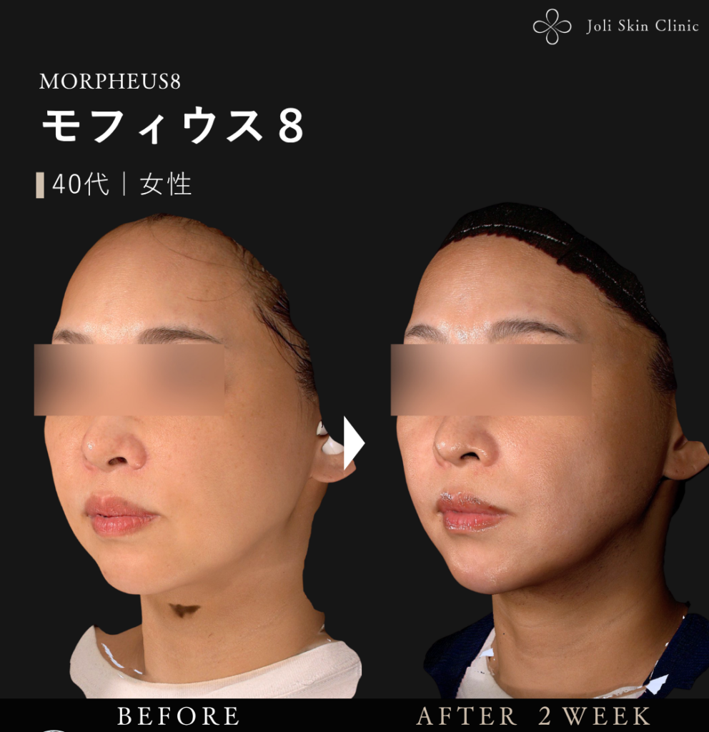 モフィウスの症例