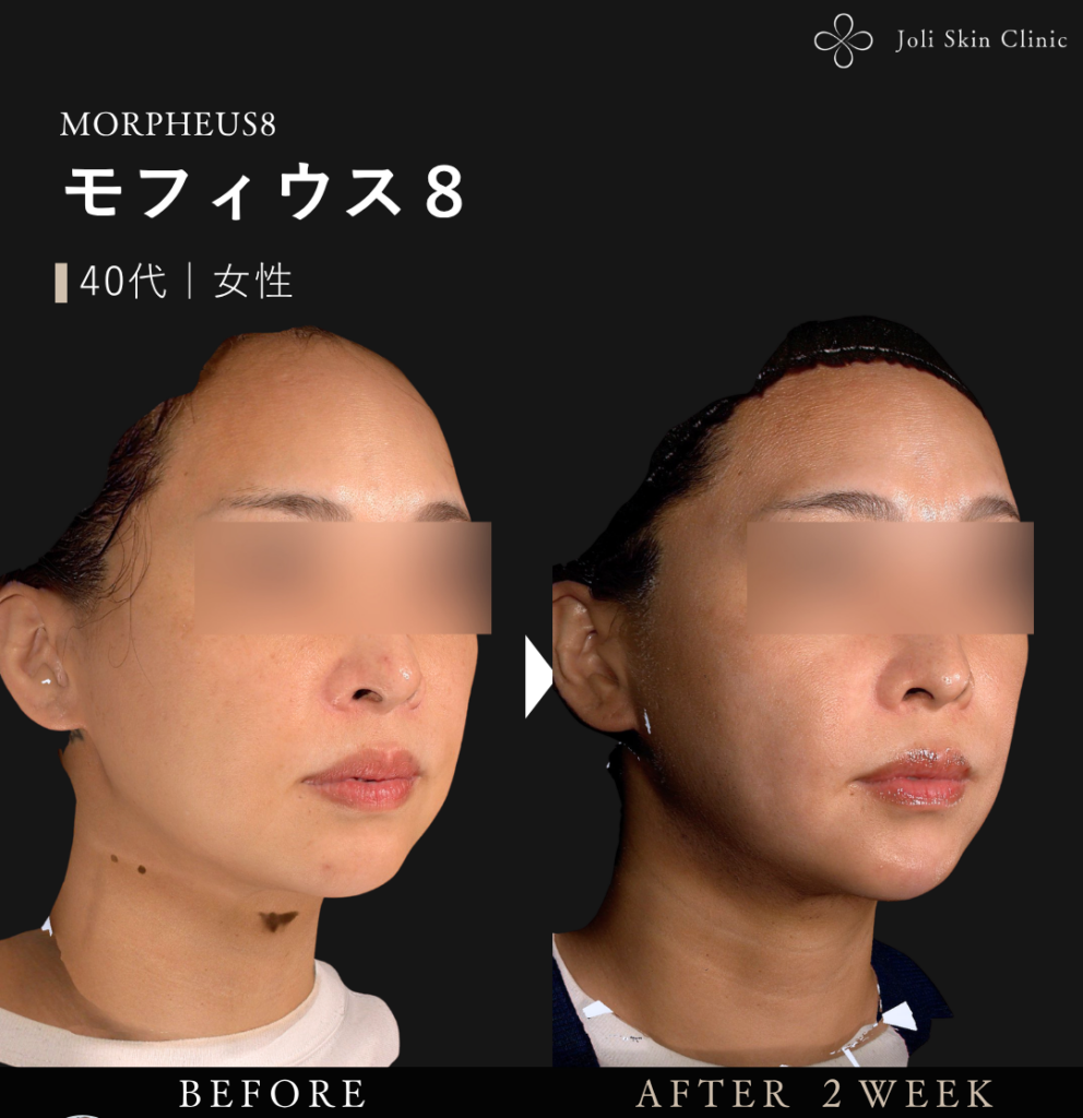 モフィウスの症例
