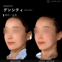 デンシティ症例