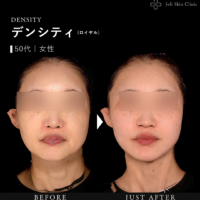 デンシティの症例