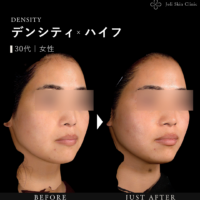 デンシティ症例
