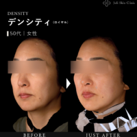 デンシティ症例