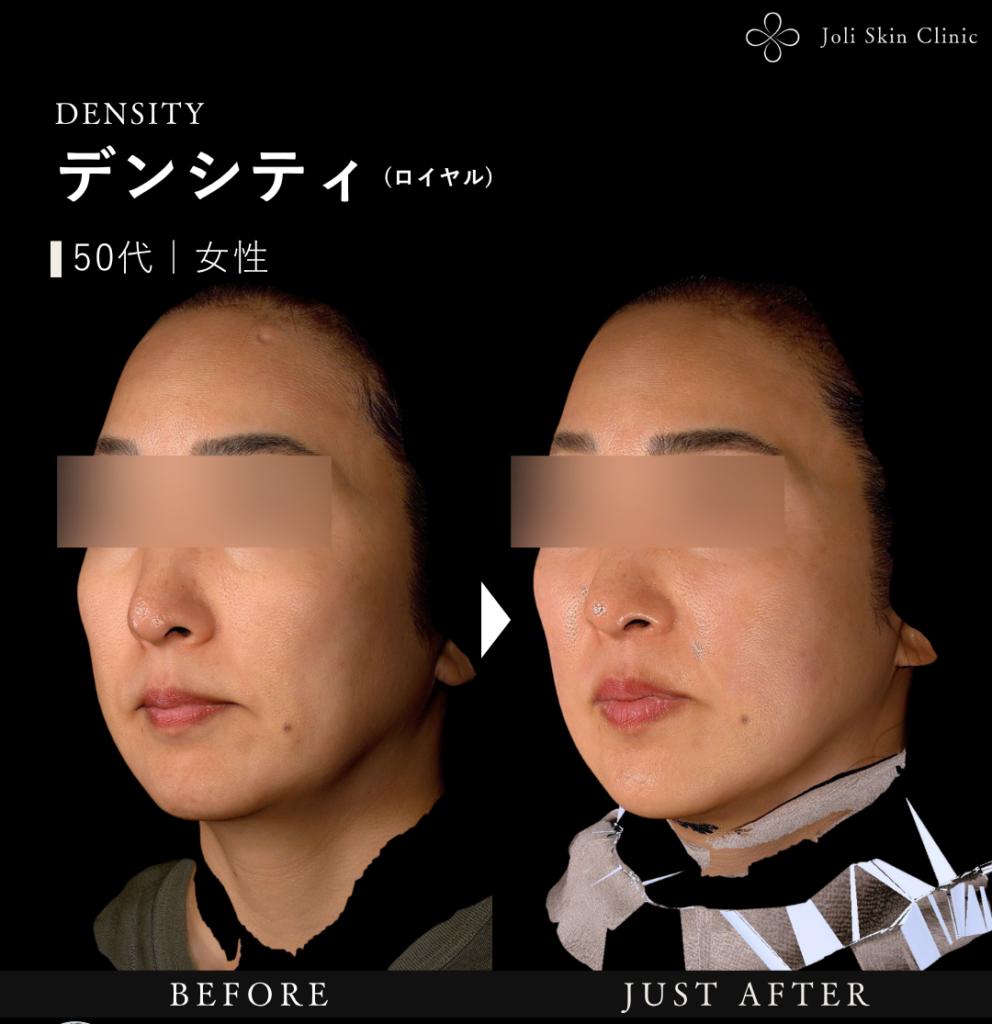 デンシティ症例