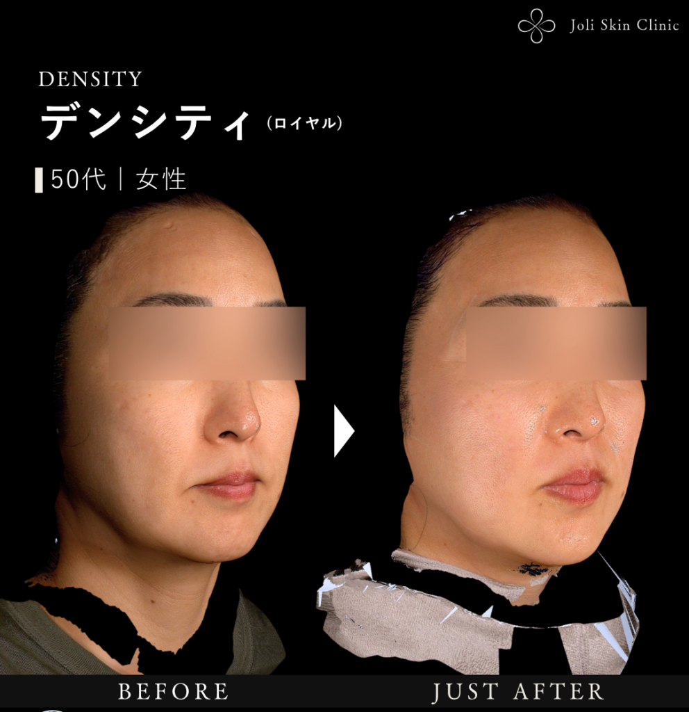 デンシティ症例