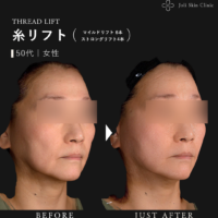 糸リフトの症例
