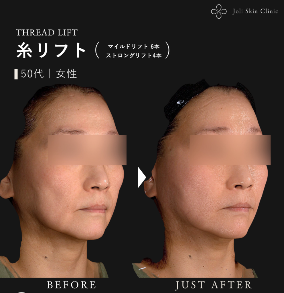 糸リフトの症例