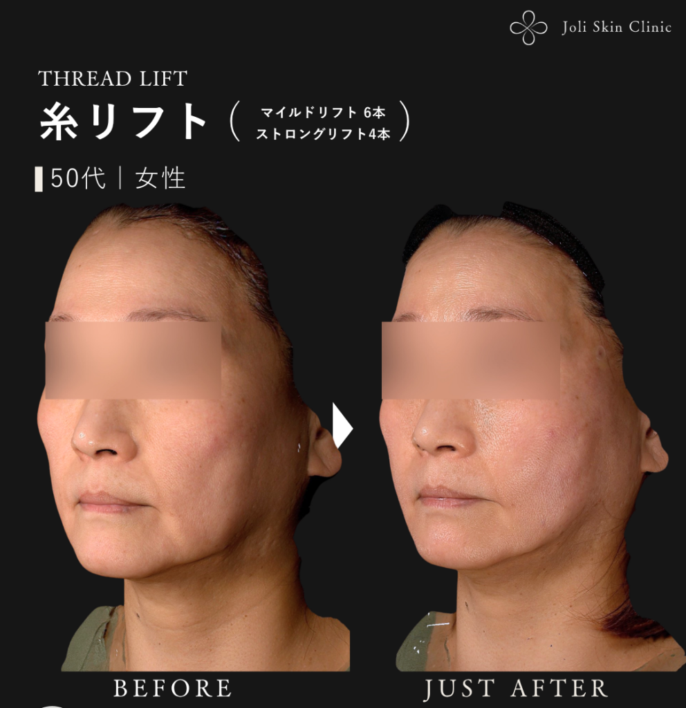 糸リフトの症例