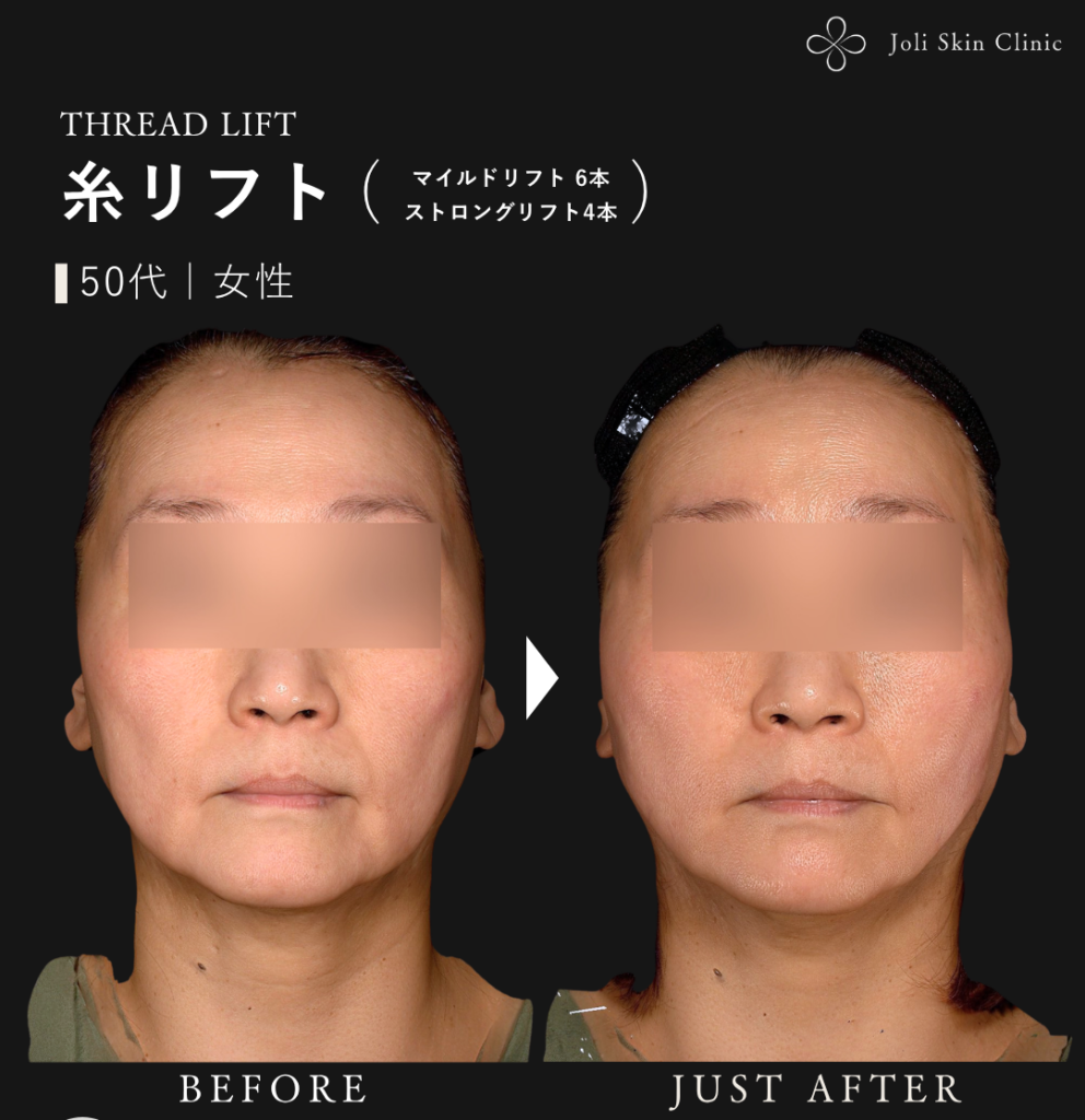 糸リフトの症例